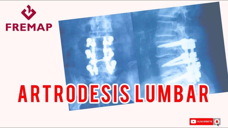 Descubre lo último en tratamientos para el dolor de espalda en el foro de artrodesis lumbar L5